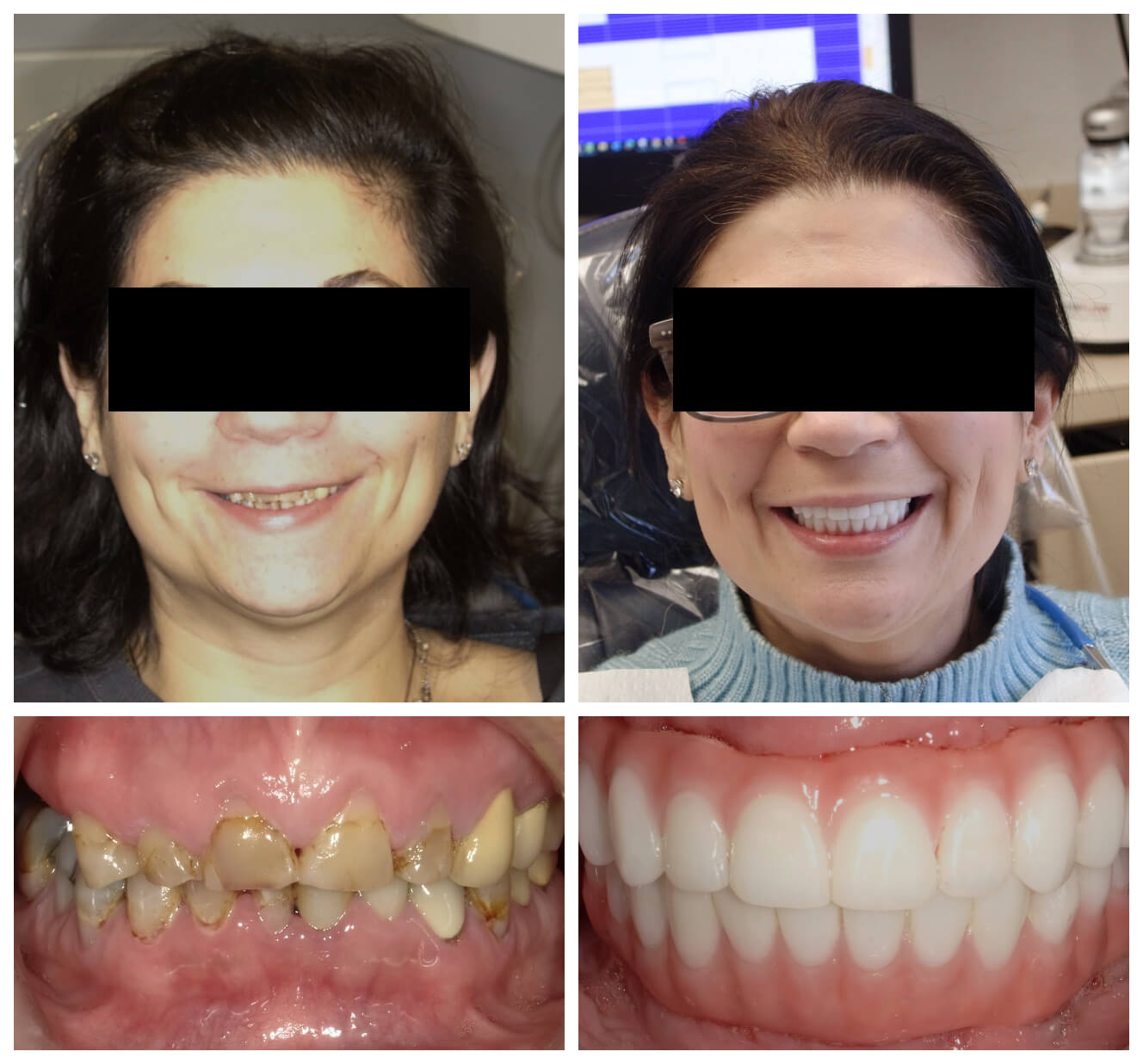 All-on-X Full-Arch Transformation before and after