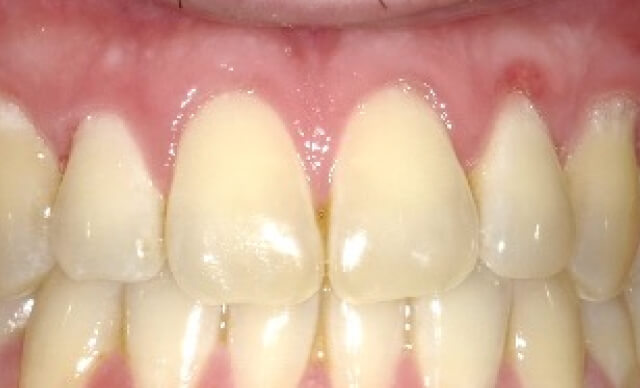 Pinhole® Gum Rejuvenation after