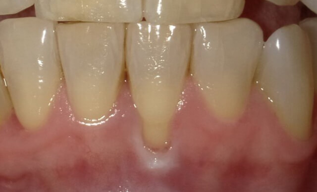 Soft Tissue Graft before
