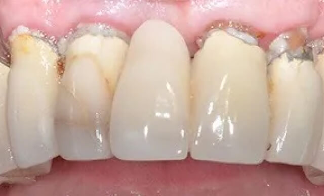 Dental Implant Restoration before