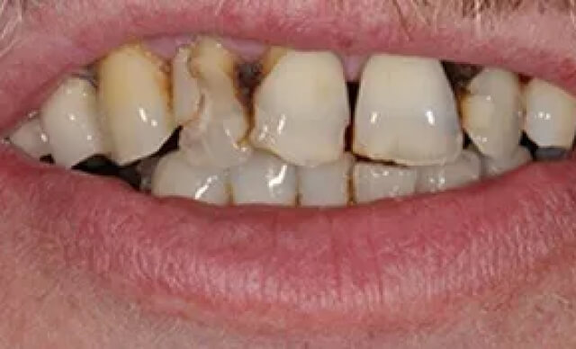Implant Smile Makeover before