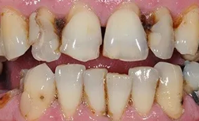 Full Smile Reconstruction before