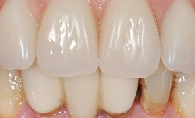 Implant-Supported Restoration after