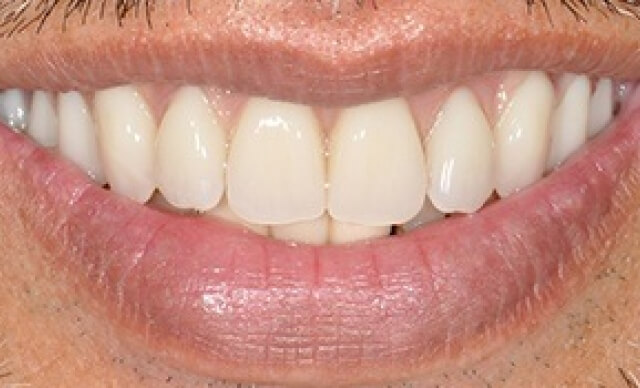 Complete Smile Renewal after