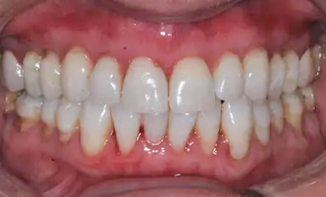 Pinhole® Gum Rejuvenation after