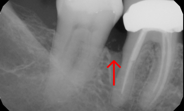After treatment