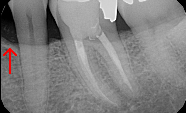 After treatment