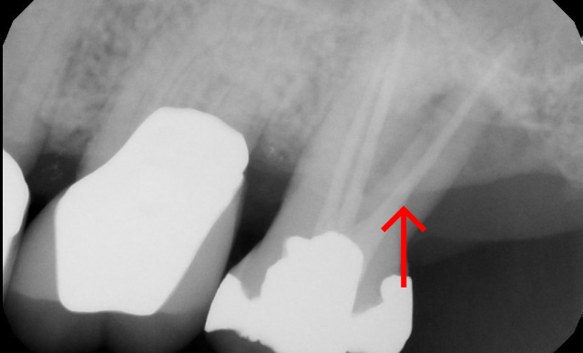 After treatment